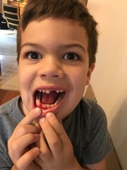 Lost Bottom Tooth